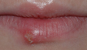 munnsår