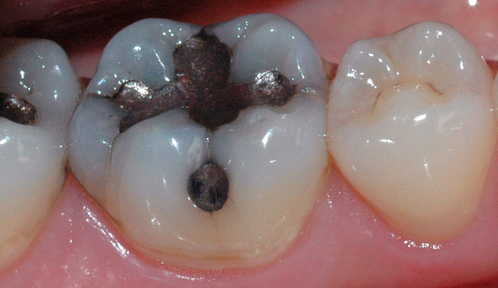 Bildet viser en jeksel i underkjeven med flere synlige infraksjonslinjer.