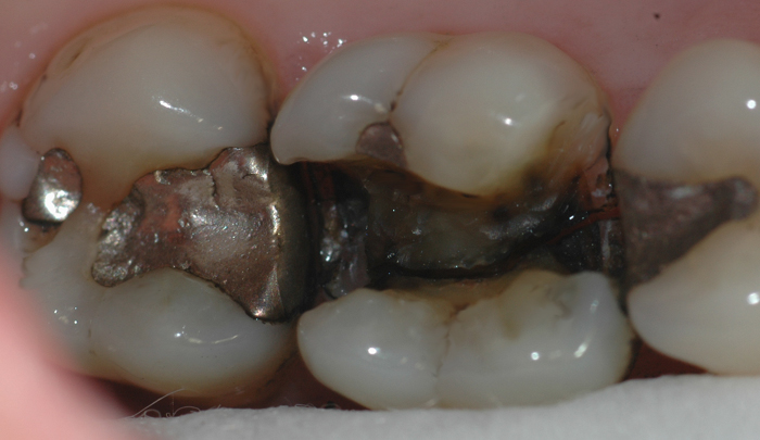 Bildet viser en tann der infraksjonslinjen over tid har ført til at tannen har delt seg i to.