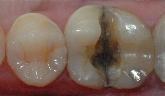 Bildet viser en tann der infraksjonslinjen over tid har ført til at tannen har delt seg i to.