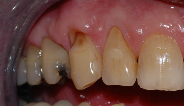 Bildet viser en stor børsteskade på en hjørnetann i overkjeven