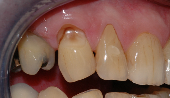 Børsteskaden er så dyp at den nærmer seg nerven i tannen