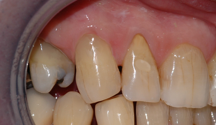 Tannen blir derfor reparert med en fylling