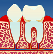 periodontitt