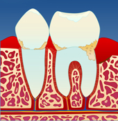 periodontitt