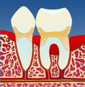 periodontitt
