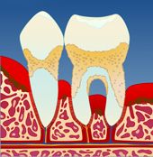 periodontitt