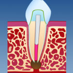 Infeksjon ved rotspissen