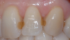 fylling etter tannbleking