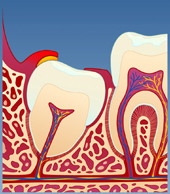 Betennelse i visdomstenner