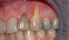 tannkjøtt ved snusing